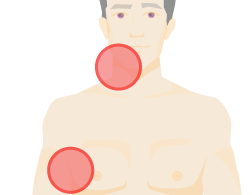 Outline of a torso showing lumps in two places